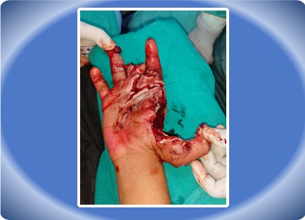 HAND INJURY